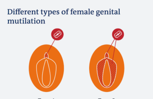International Day of Zero Tolerance for FGM: UNFPA, CCPRH, CSOs Lend Voices to FGM Survivors
